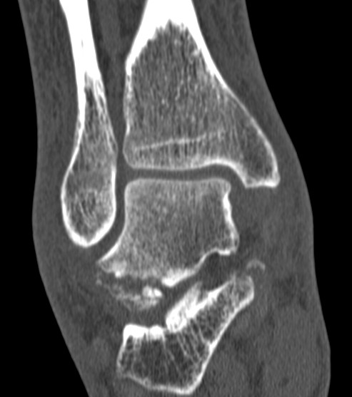 Talus Lateral Process Fracture CT